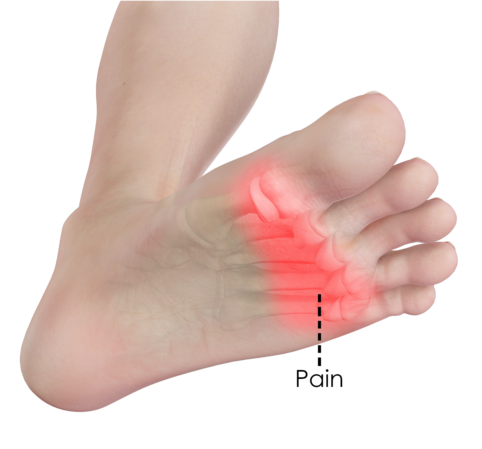 Forefoot Pain Treatment Springfield 
