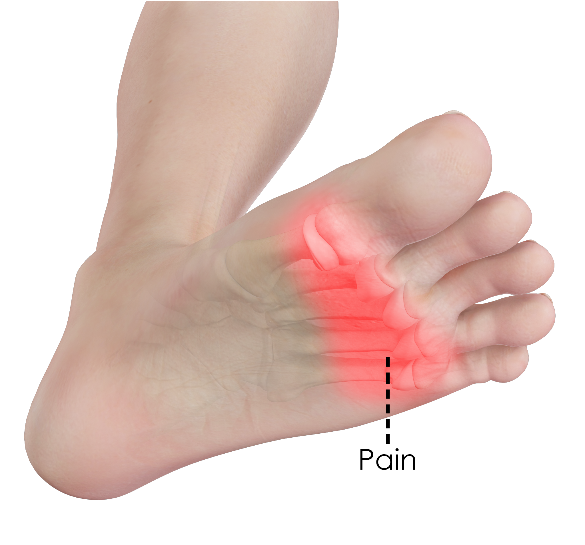 86 TREATMENT METATARSAL PAIN Treatment Pain