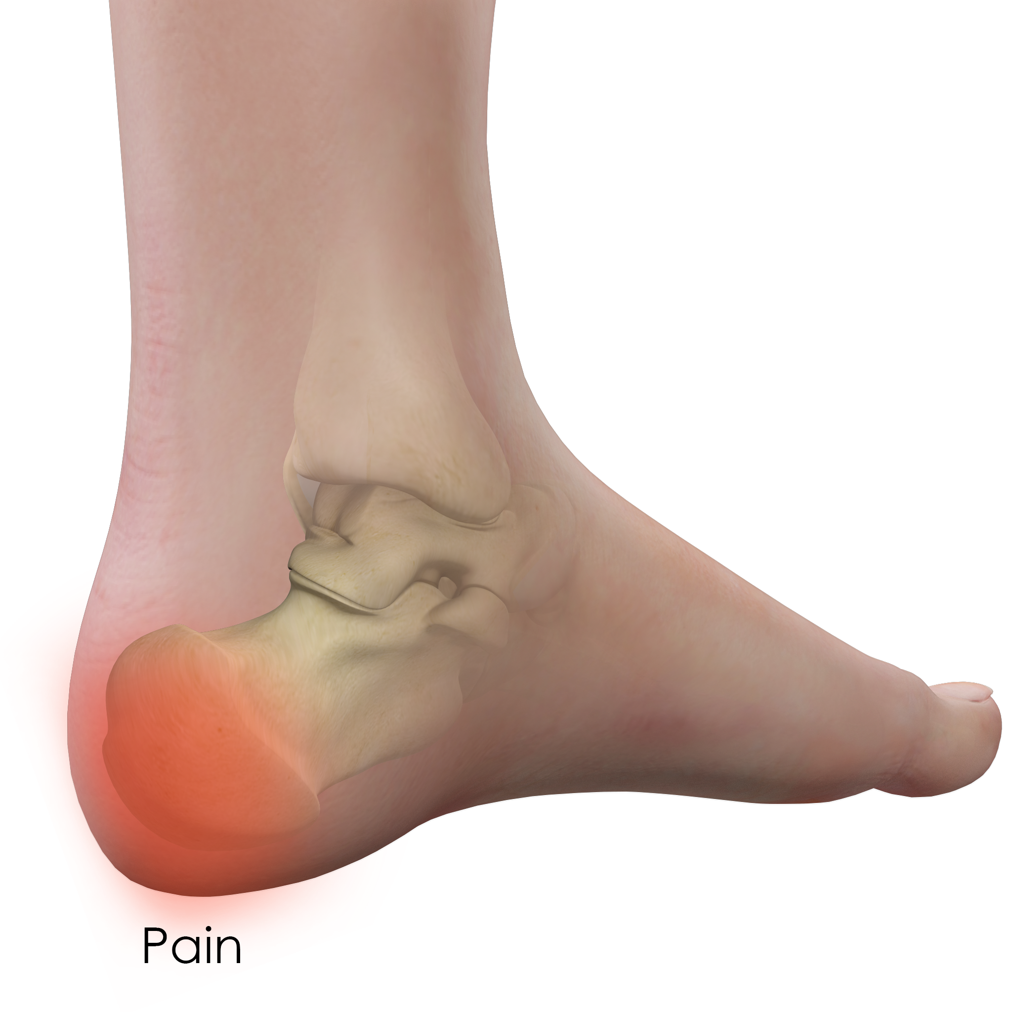 swelling on back of heel bone