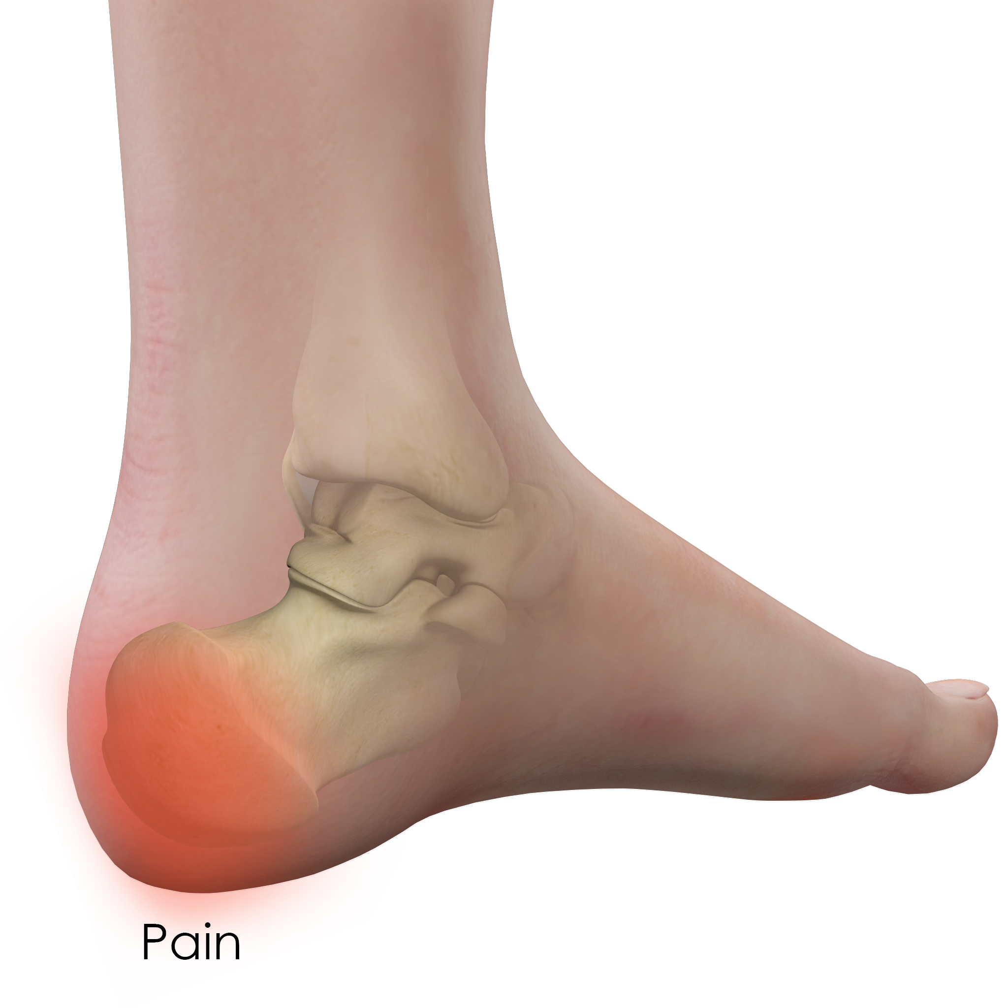 Heel Pain Treatment East Longmeadow Plantar Fasciitis Chicopee 