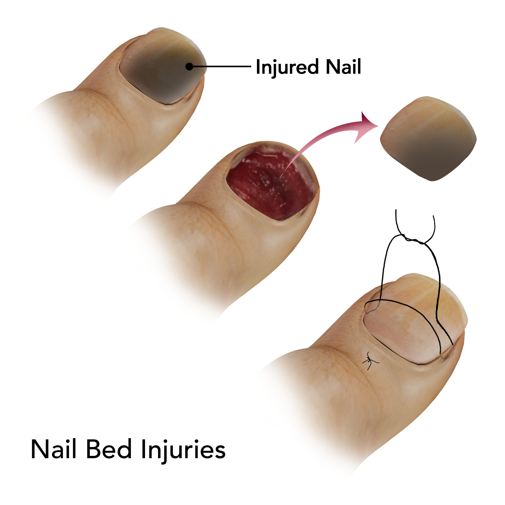 Nail Bed Injuries Springfield Nail Injuries Treatment East Longmeadow 